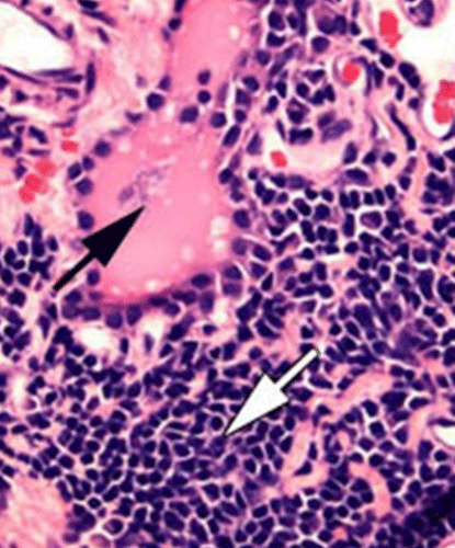 Thyroiditis chronic lymphocytic Lymphocytic thyroiditis following hyperthyroidism